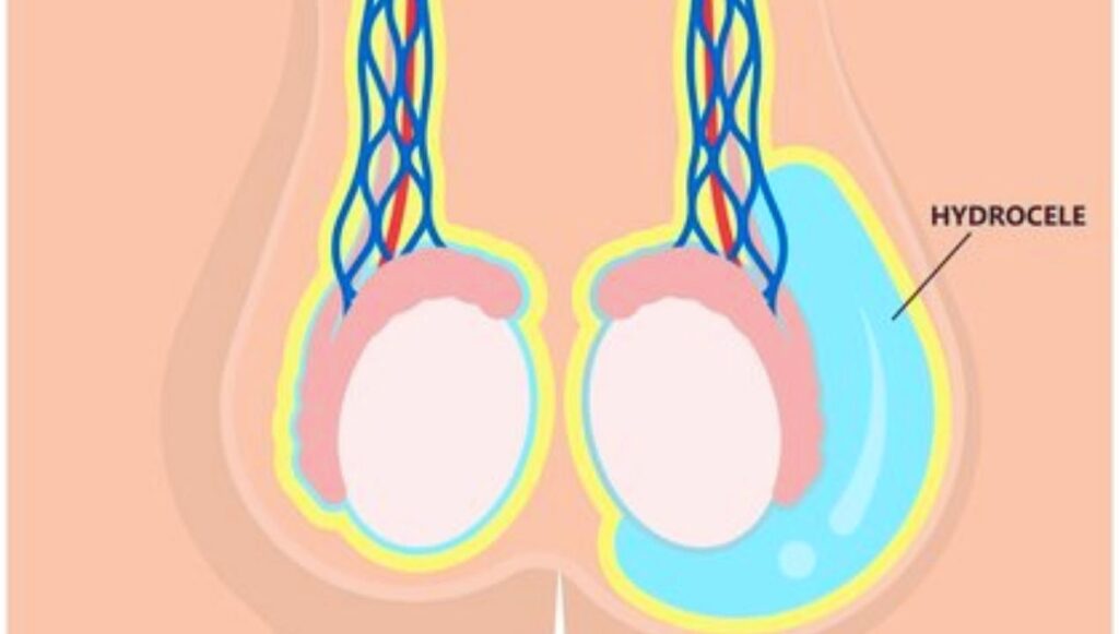 القيلة المائية بدون جراحة​
