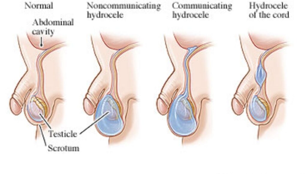 تكلفة عملية القيلة المائية