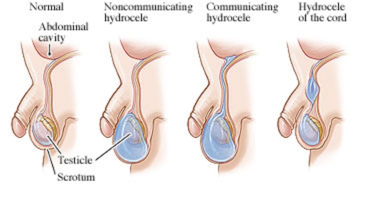 تكلفة عملية القيلة المائية في مصر: الأسعار المتوقعة