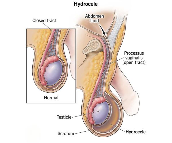 عملية القيلة المائية