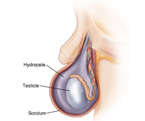 تكلفة عملية القيلة المائية