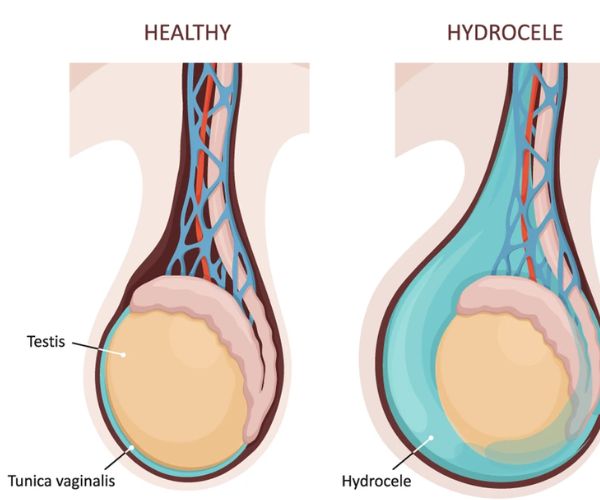 عملية القيلة المائية