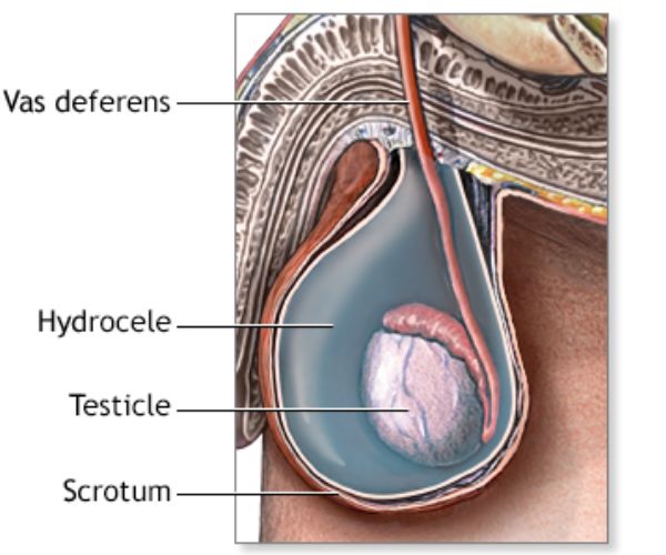 عملية القيلة المائية