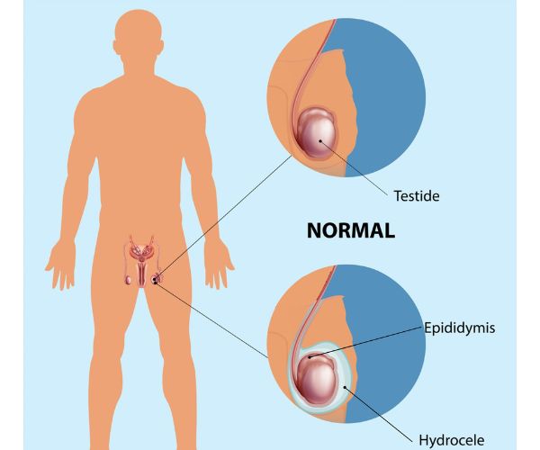 تكلفة عملية القيلة المائية