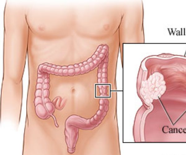 اعراض اعصاب القولون