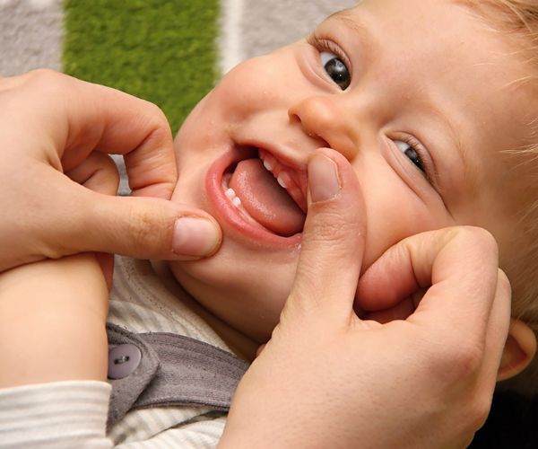 الشفة المربوطة عند الرضع