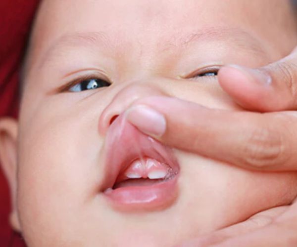 الشفة المربوطة عند الرضع