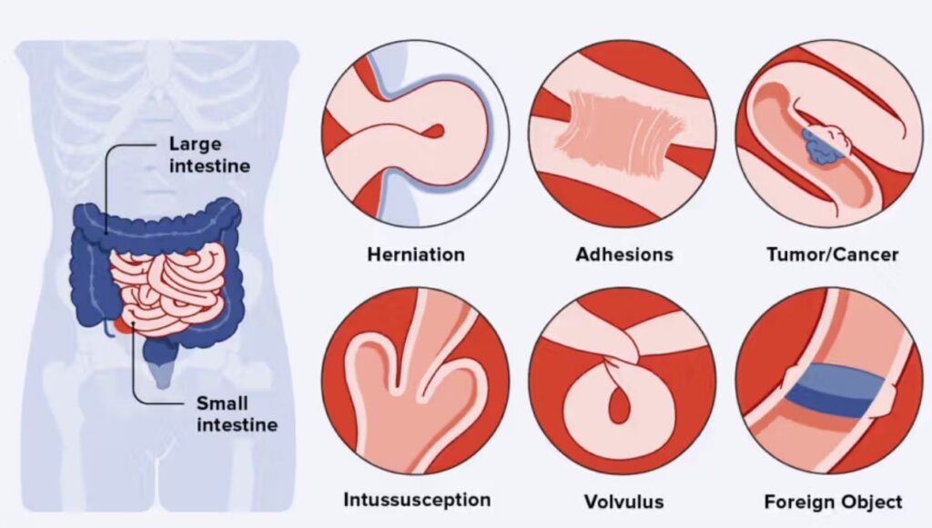 الانسداد المعوي عند الأطفال