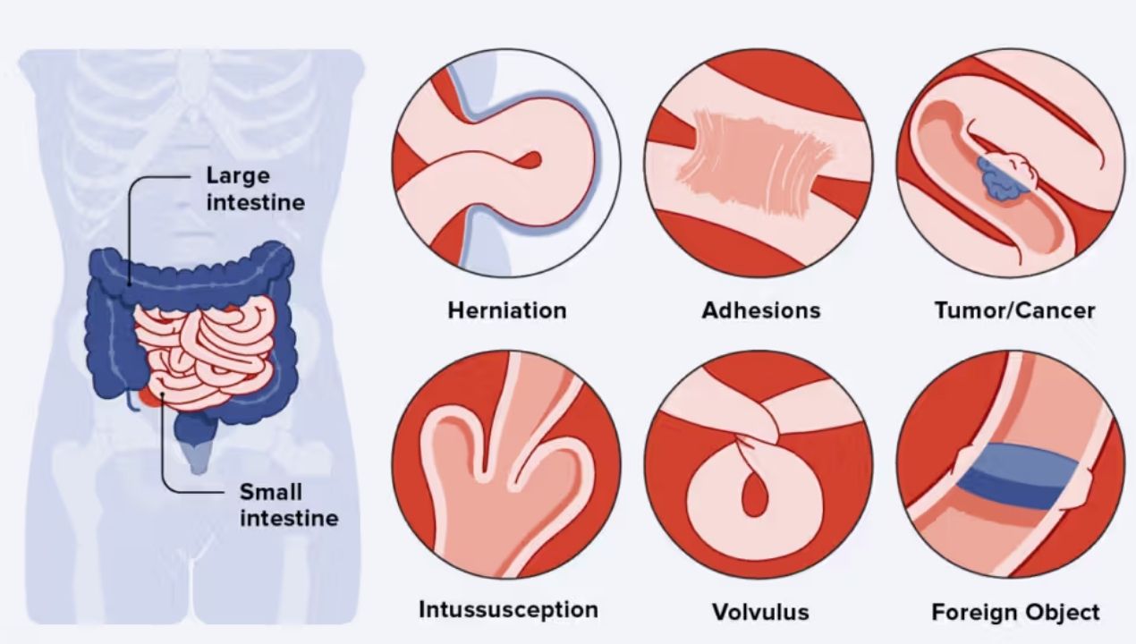الانسداد المعوي عند الأطفال: الأعراض والعلاج