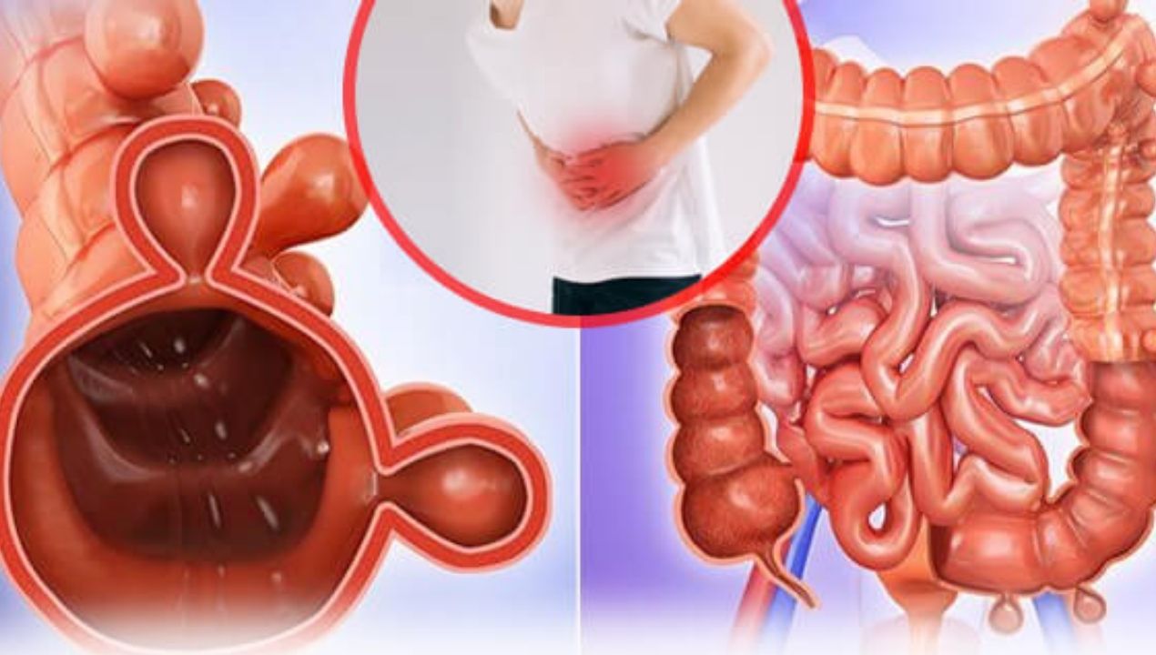 كم تستغرق عملية انسداد الأمعاء؟ تفاصيل للمدة والتعافي