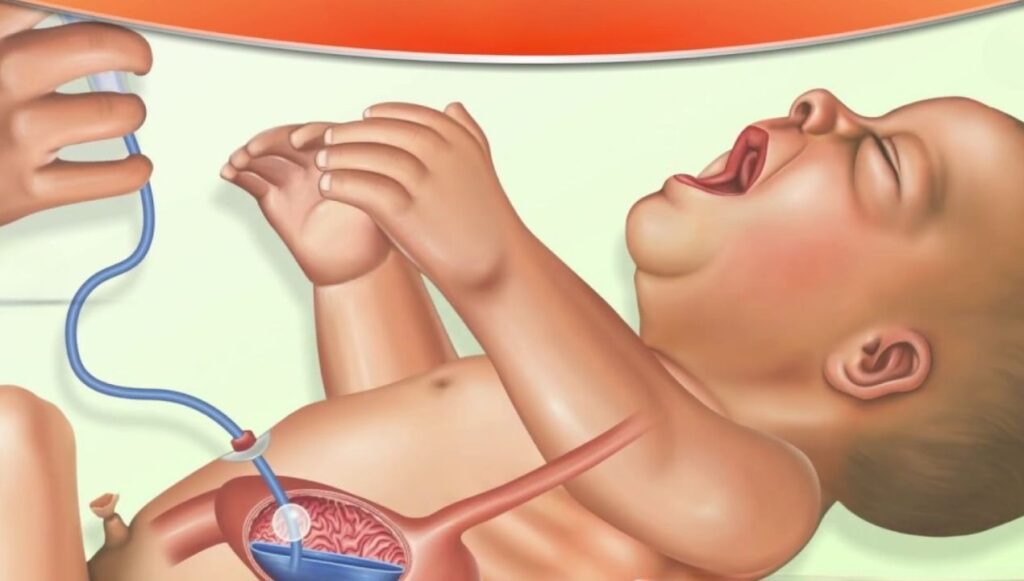 أسباب رتق المريء عند حديثي الولادة