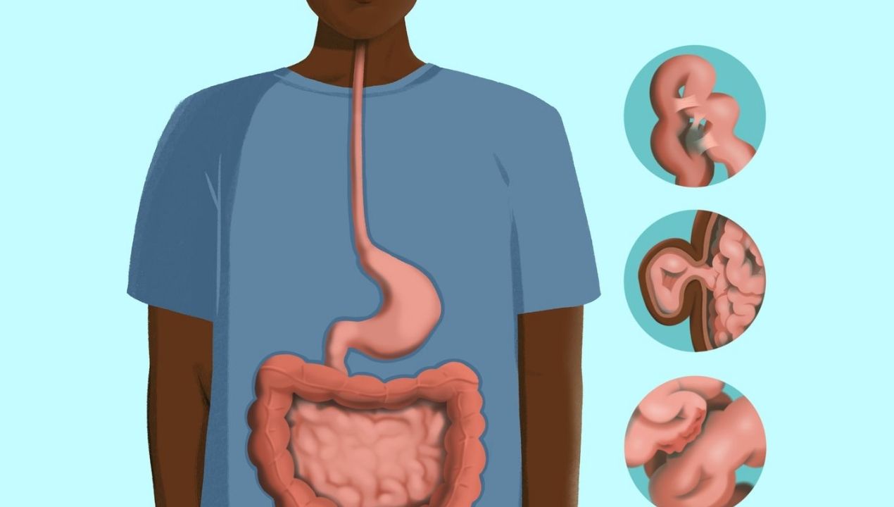 هل انسداد الأمعاء يسبب الوفاة؟ متى يصبح خطيرًا؟