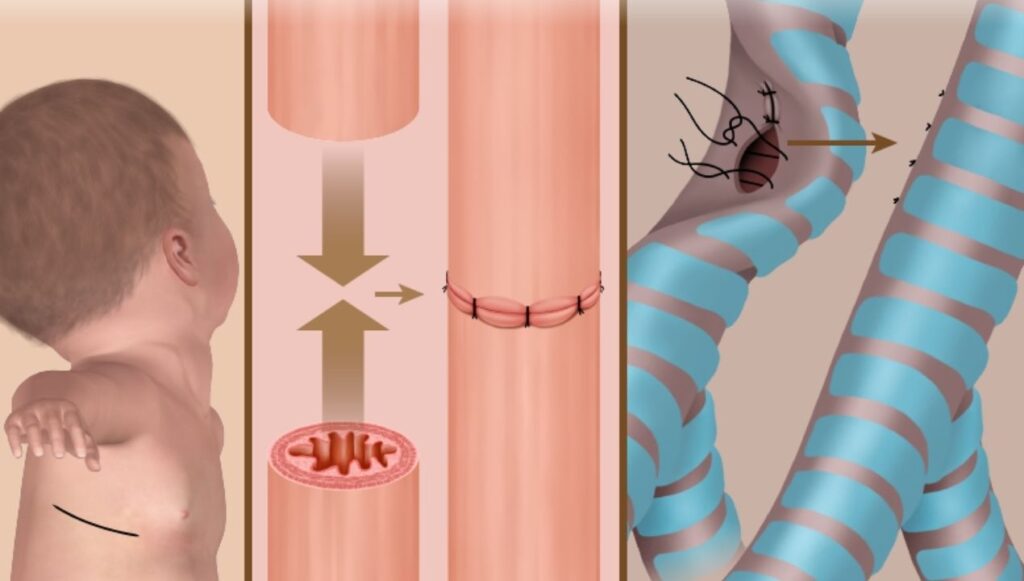 ما بعد عملية رتق المريء