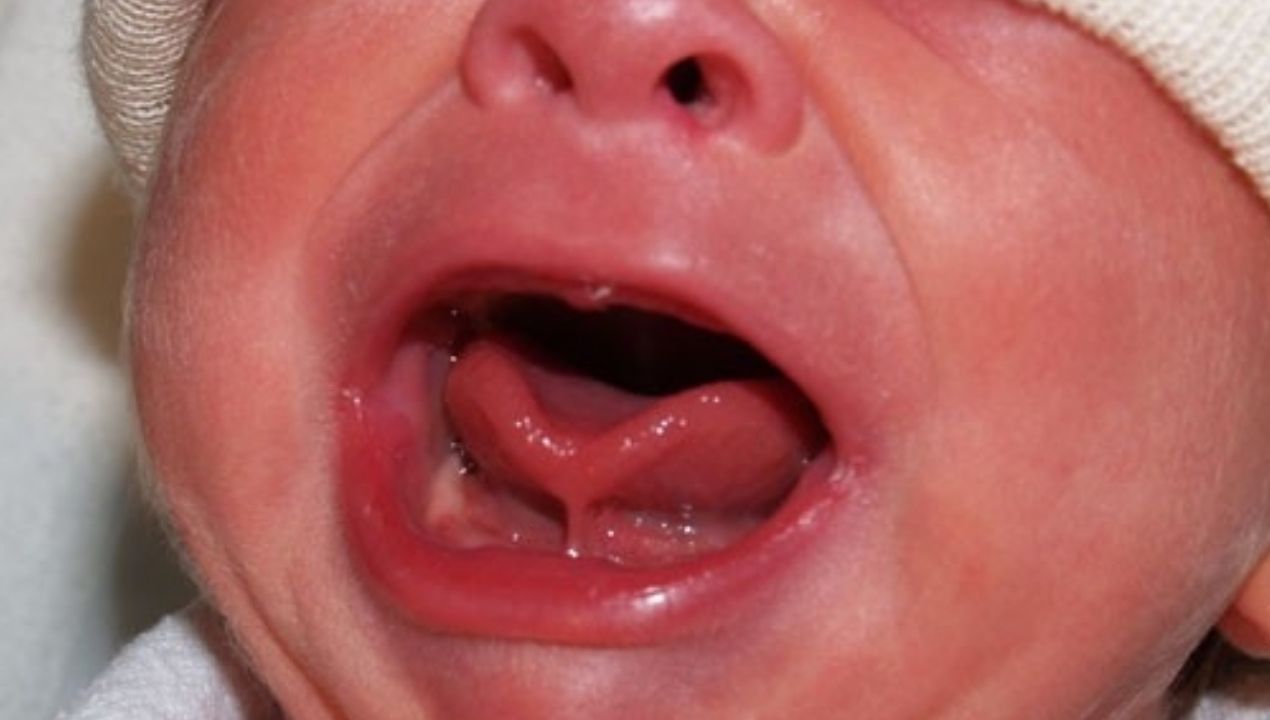 علامات اللسان المربوط عند الرضع: دليل مصور للأمهات