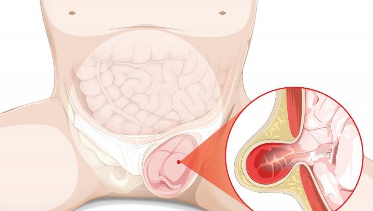 ما هو الفتق الاربي؟ الأسباب والأعراض وطرق العلاج