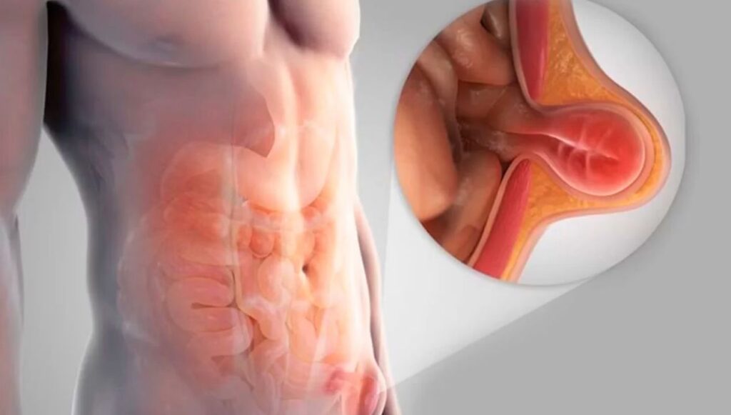 نصائح بعد عملية الفتق الاربي للرجال