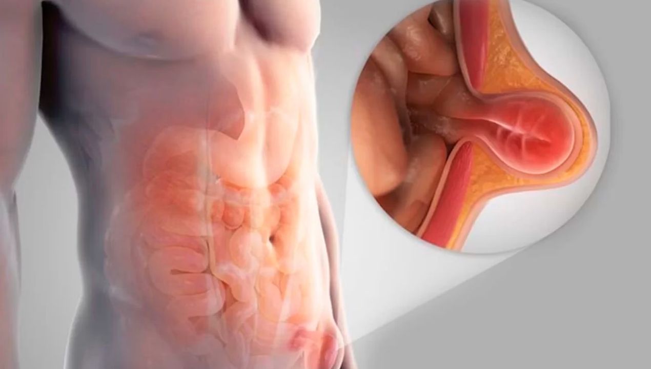 أهم 10 نصائح بعد عملية الفتق الاربي للرجال​ لضمان الشفاء