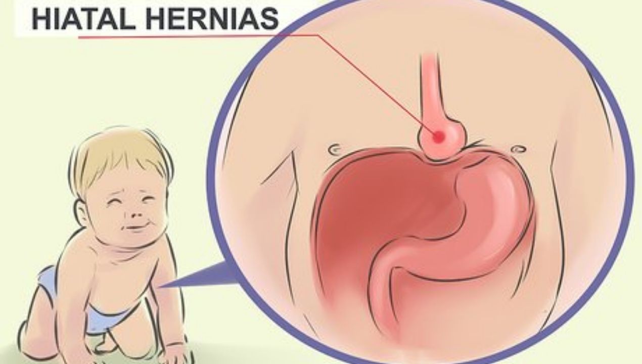 ما هي أعراض الفتق عند الأطفال البنات: الاعراض و العلاج