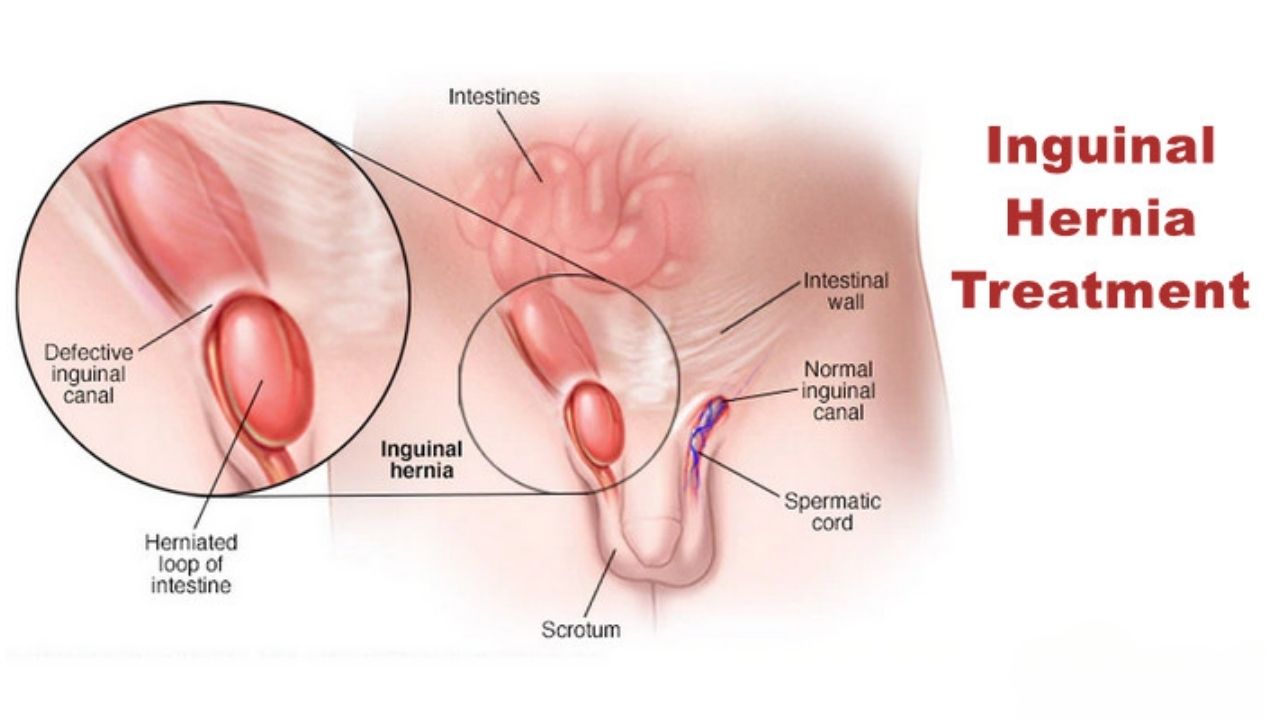 الفتق الإربي في الخصية: الأعراض والتشخيص وخيارات العلاج