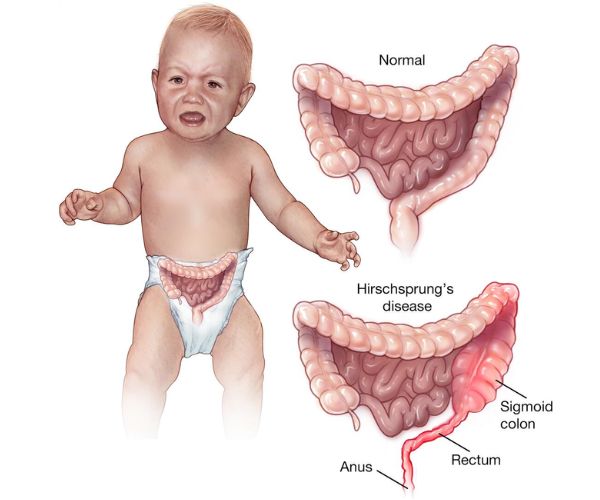 كم نسبة نجاح عملية هيرشسبرينجكم