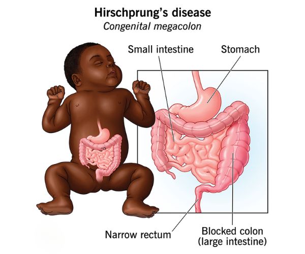 كم نسبة نجاح عملية هيرشسبرينجكم