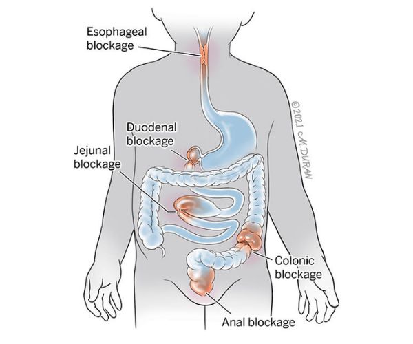 طرق علاج ضيق المريء