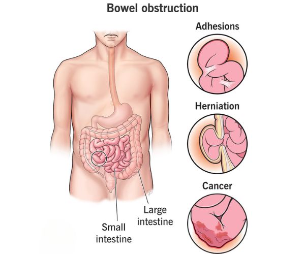 انسداد الأمعاء يسبب الوفاة