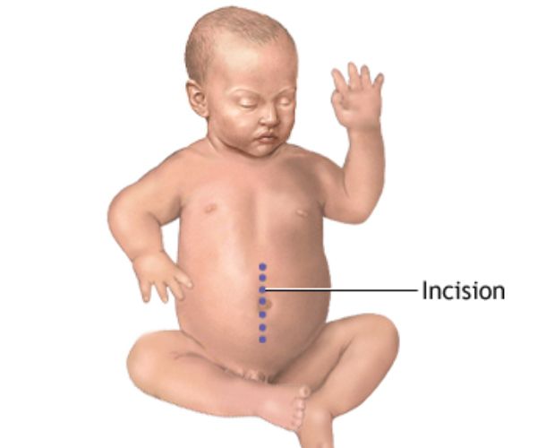 عملية التواء الأمعاء عند الأطفال