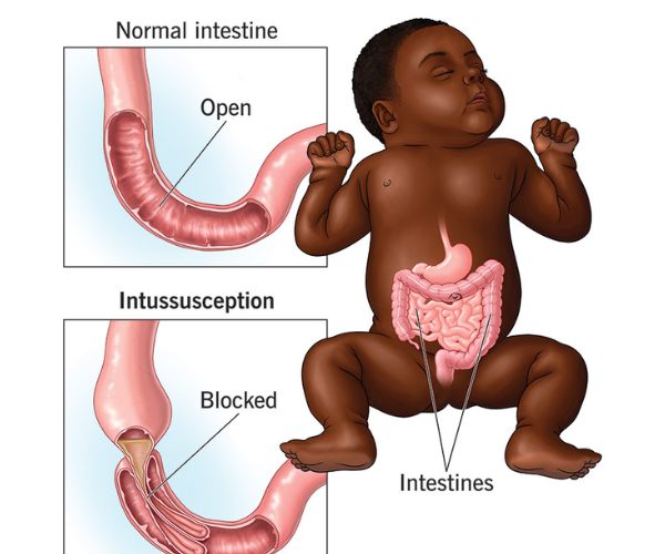 انسداد الأمعاء يسبب الوفاة