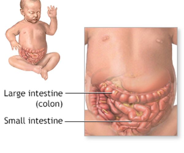 انسداد الأمعاء يسبب الوفاة