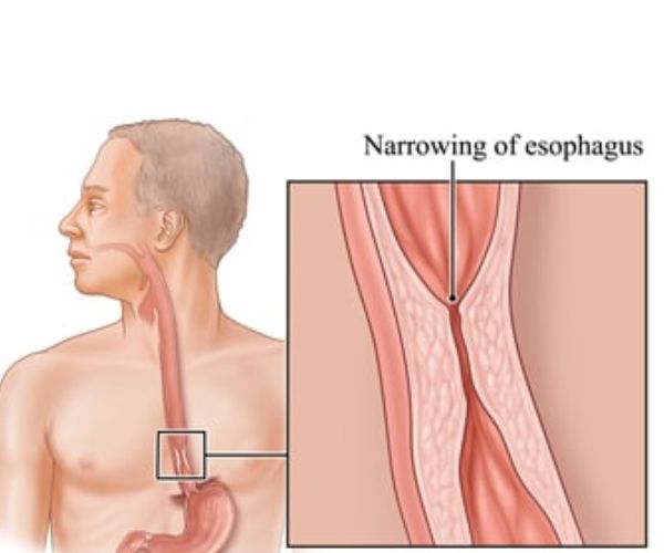 طرق علاج ضيق المريء