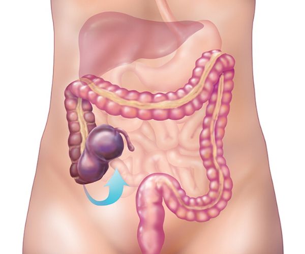 عملية التواء الأمعاء عند الأطفال