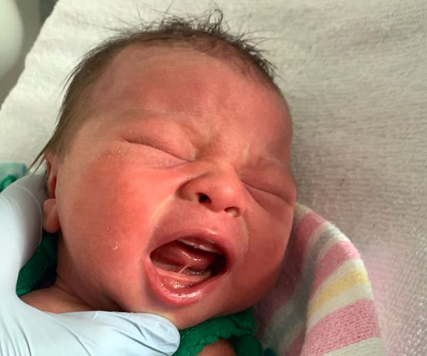 اللسان المربوط عند الرضع