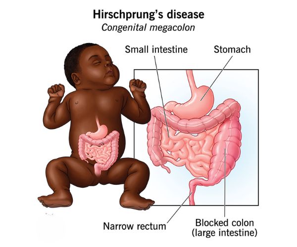 ما بعد عملية الهيرشسبرنج