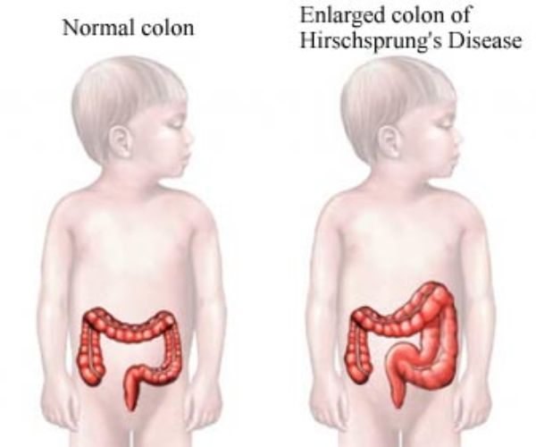 أعراض مرض هيرشسبرونغ بالتفصيل