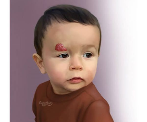 الوحمة الدموية