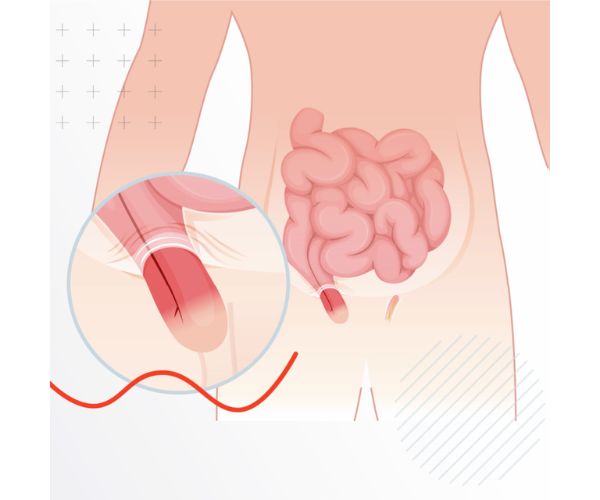 نصائح بعد عملية الفتق الاربي للرجال