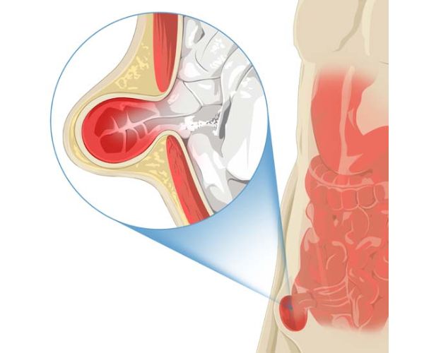 نصائح بعد عملية الفتق الاربي للرجال