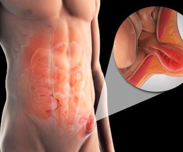 نصائح بعد عملية الفتق الاربي للرجال