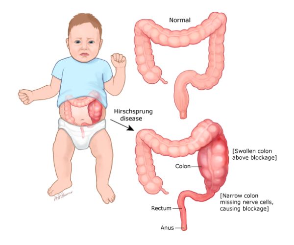 هل مرض هيرشسبرونغ وراثي