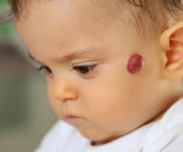 الوحمة الدموية