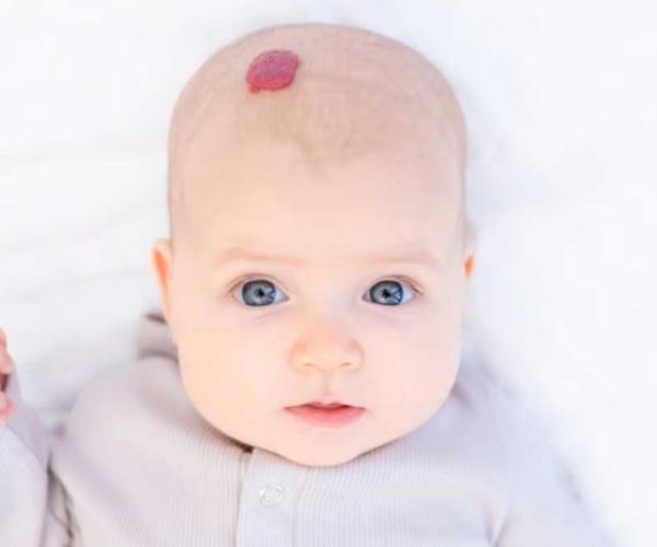 الوحمة الدموية