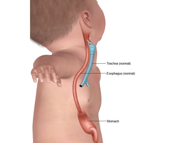 انسداد المرئ