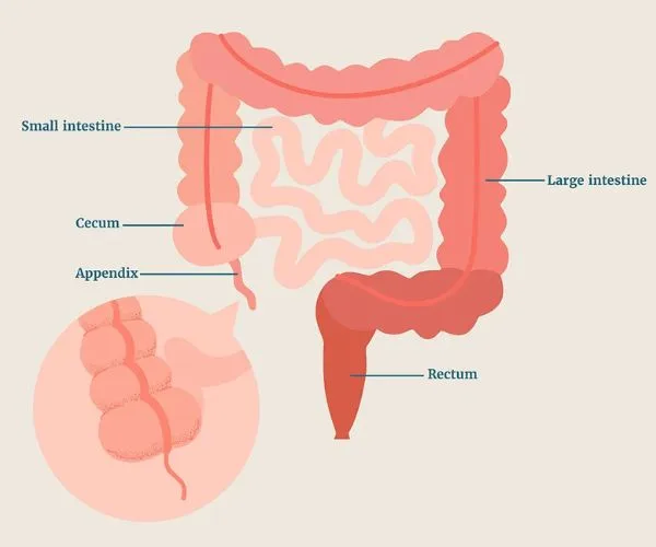 علاج التهاب الزائدة الدودية