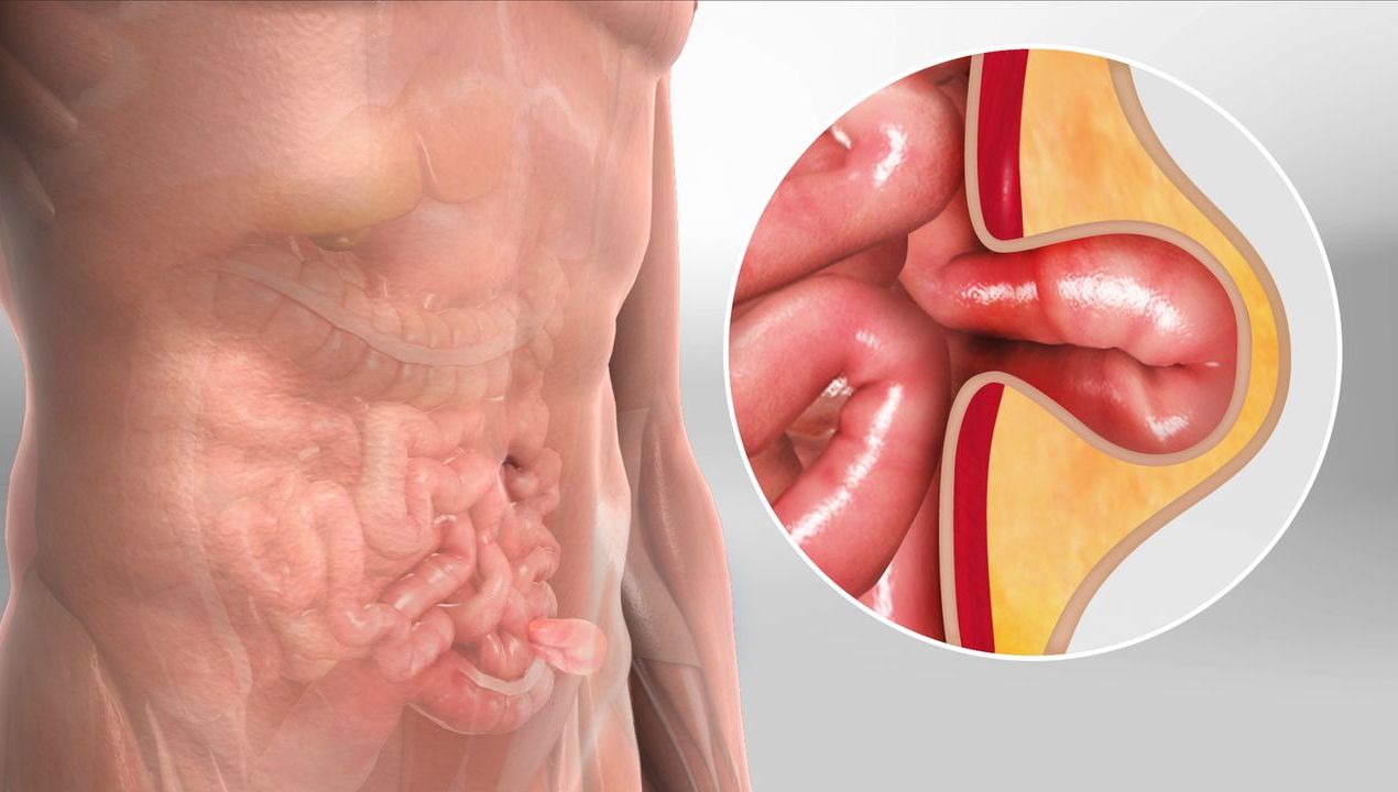 علاج الفتق الاربي​: المضاعفات والعلاج وهل يزول مع الوقت