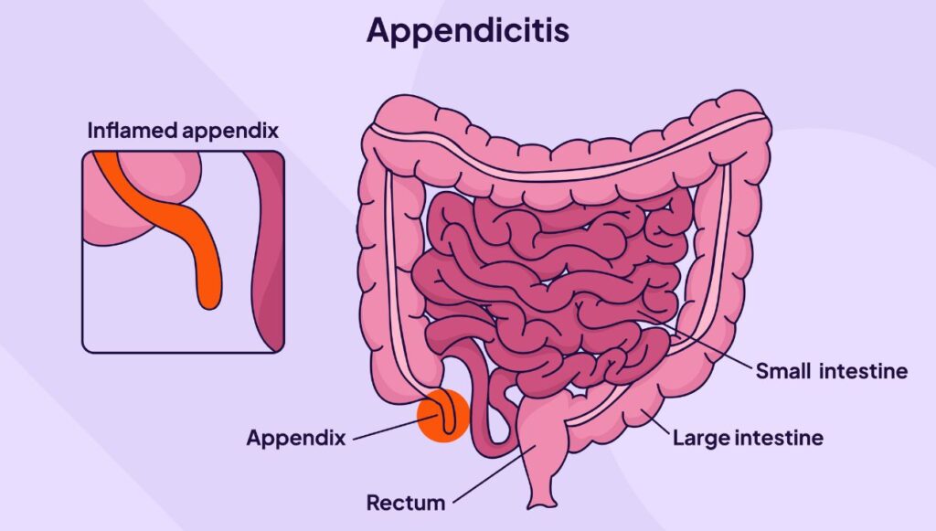 التهاب الزائدة الدودية