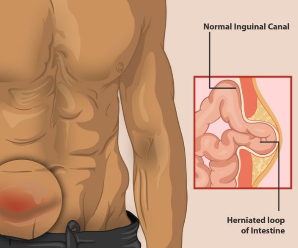 علاج الفتق بالتدليك