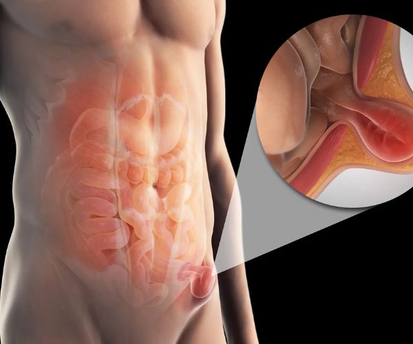 الفتق اسفل البطن​