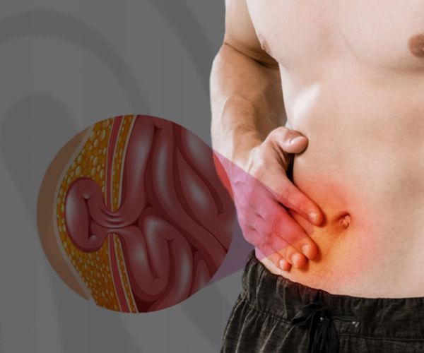 الفتق اسفل البطن​