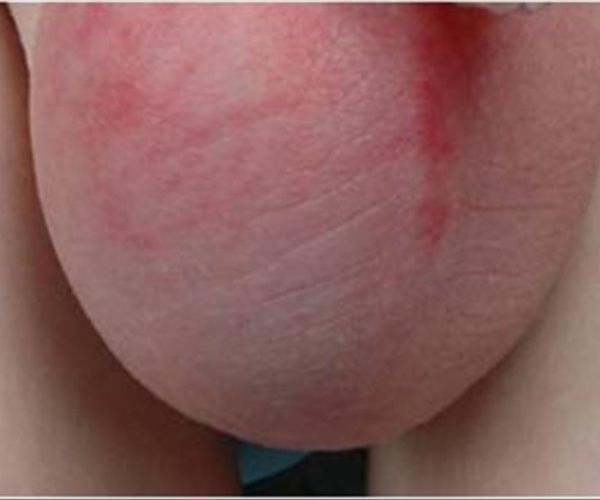 تورم الخصية اليمنى عند الاطفال